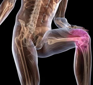 Артроз коленного сустава