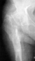 После удаления эндопротеза