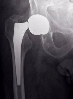 Перелом эндопротеза-1