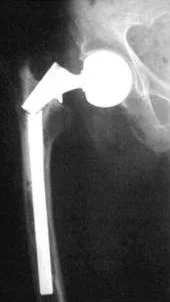 Перелом эндопротеза-2
