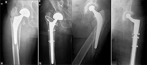 Парапротезный перелом