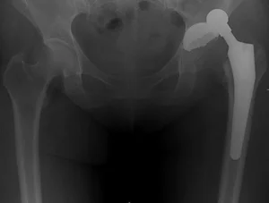 Вывих тазобедренного эндопротеза