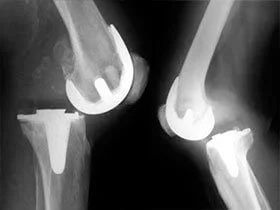 Вывих коленного эндопротеза