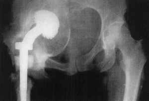 Протрузия вертлужной впадины