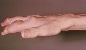 Подагрический тофус