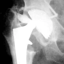 Разрушение вкладыша эндопротеза